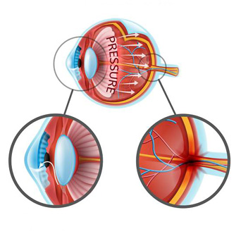 glaucome pression oculaire